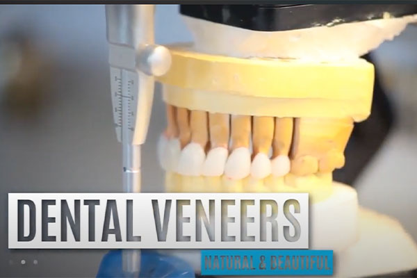 video explaining veneers in Pasadena