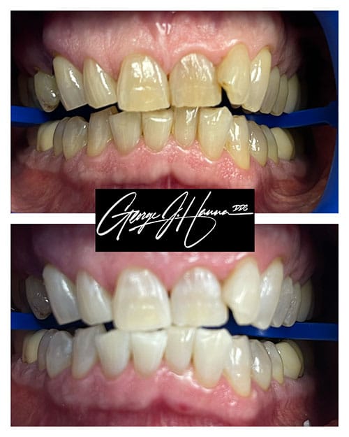 teeth-whitening-6