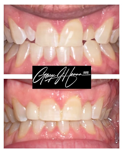 veneers 4