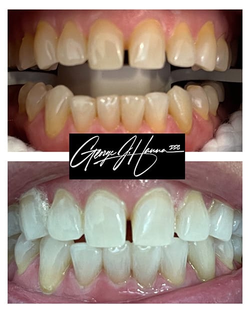 whitening 6