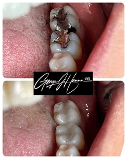 inlay, same day porcelain inlays