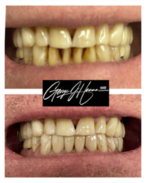 lower-porcelain-veneers
