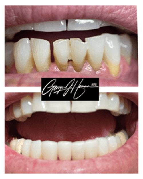 lower-veneers