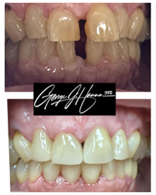 teeth-whitening-veneers-16
