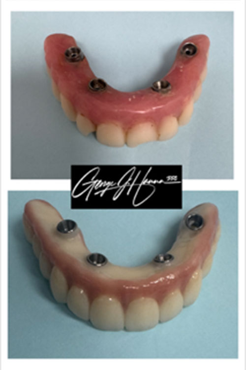 All-on-Fours-1implants full arch prosthetic supported by dental implants in Pasadena showing implant posts and custom restoration designed for a secure natural looking smile