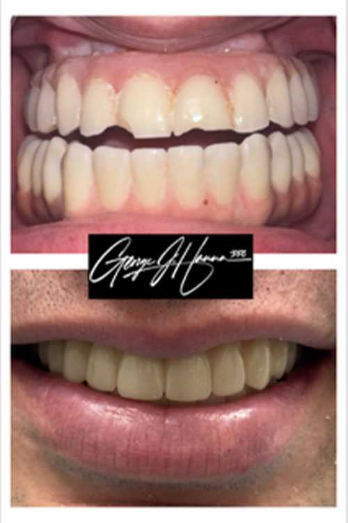 All-on-Fours-2-1implants